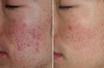 before-after acne1
